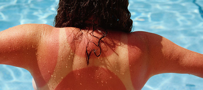 Ξεφλούδισμα δέρματος από τον ήλιο (4)